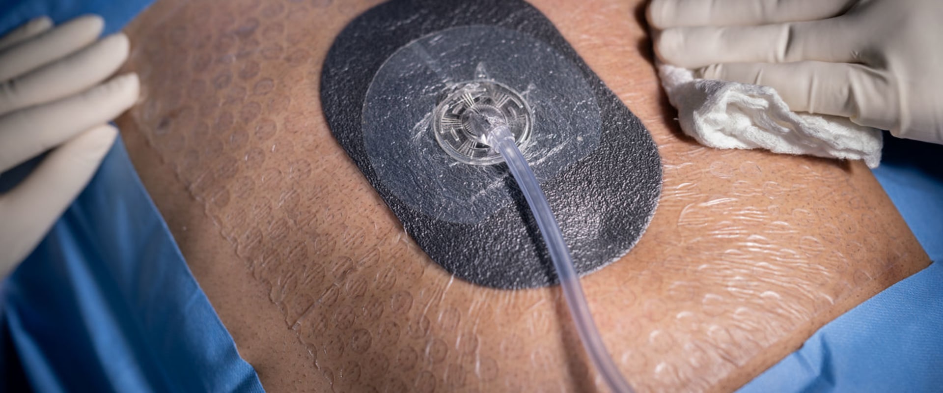 The Power of Wound Vacs: How They Can Revolutionize Wound Healing