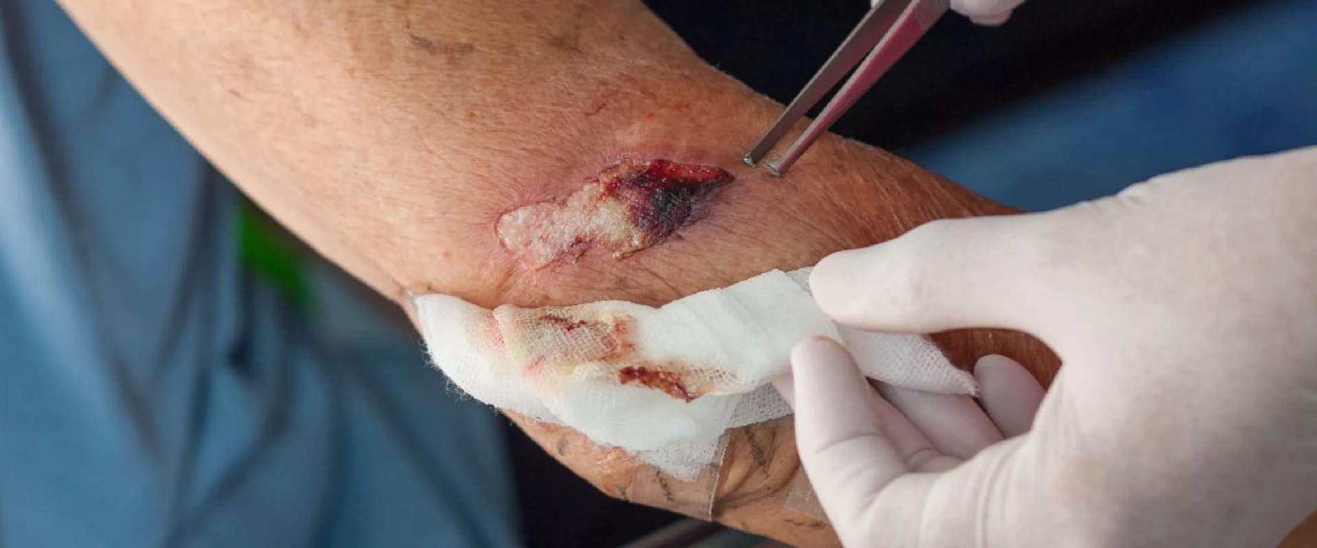 Infected Cuts and Wound Care: What Does an Infected Cut Look Like and How Wound Vac Aids Recovery