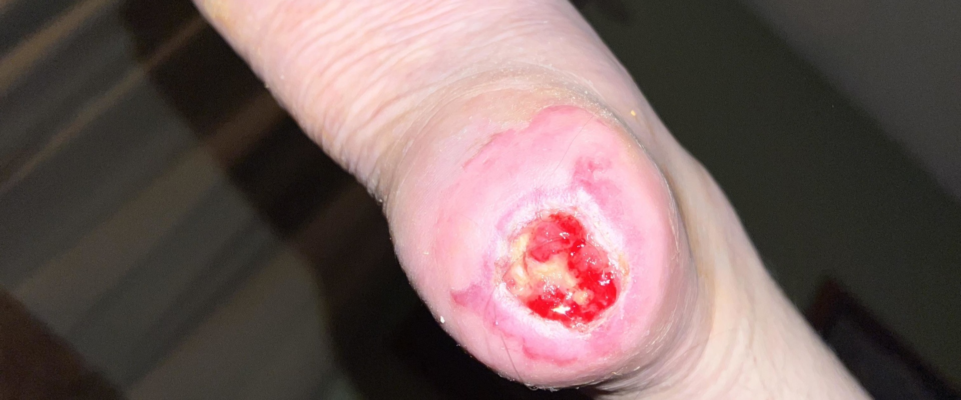 The Healing Power of Wound Vacuums: How Long Do You Need to Use Them?