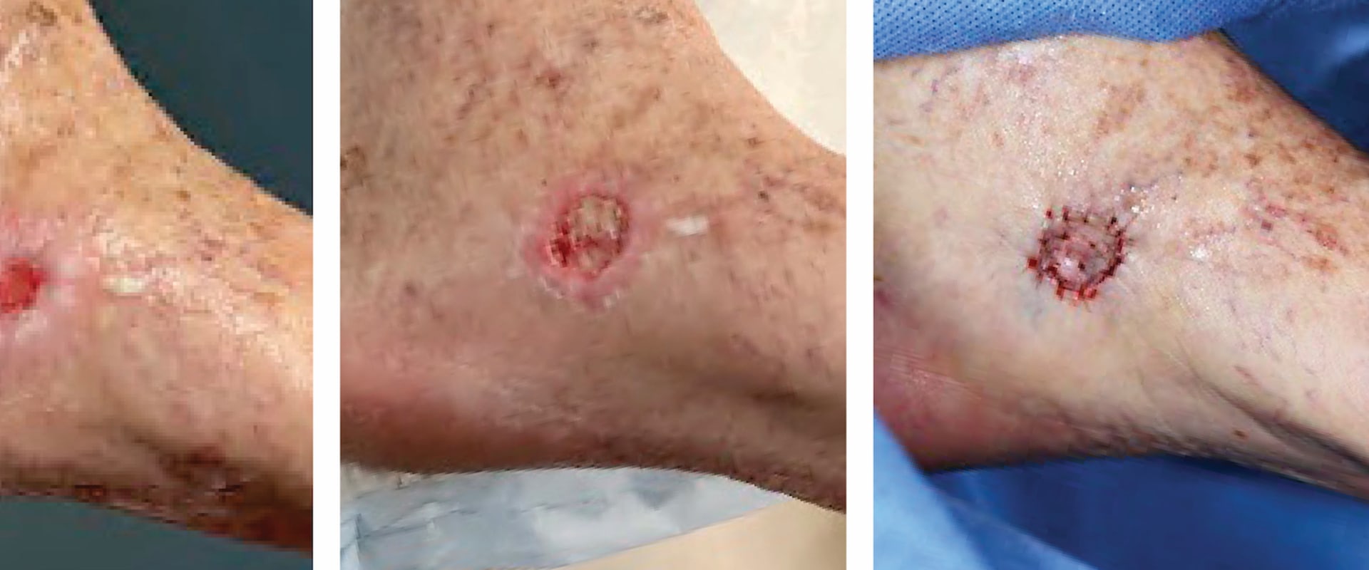 The Process of Wound Aspiration Therapy: What Happens After a Vac Dressing?