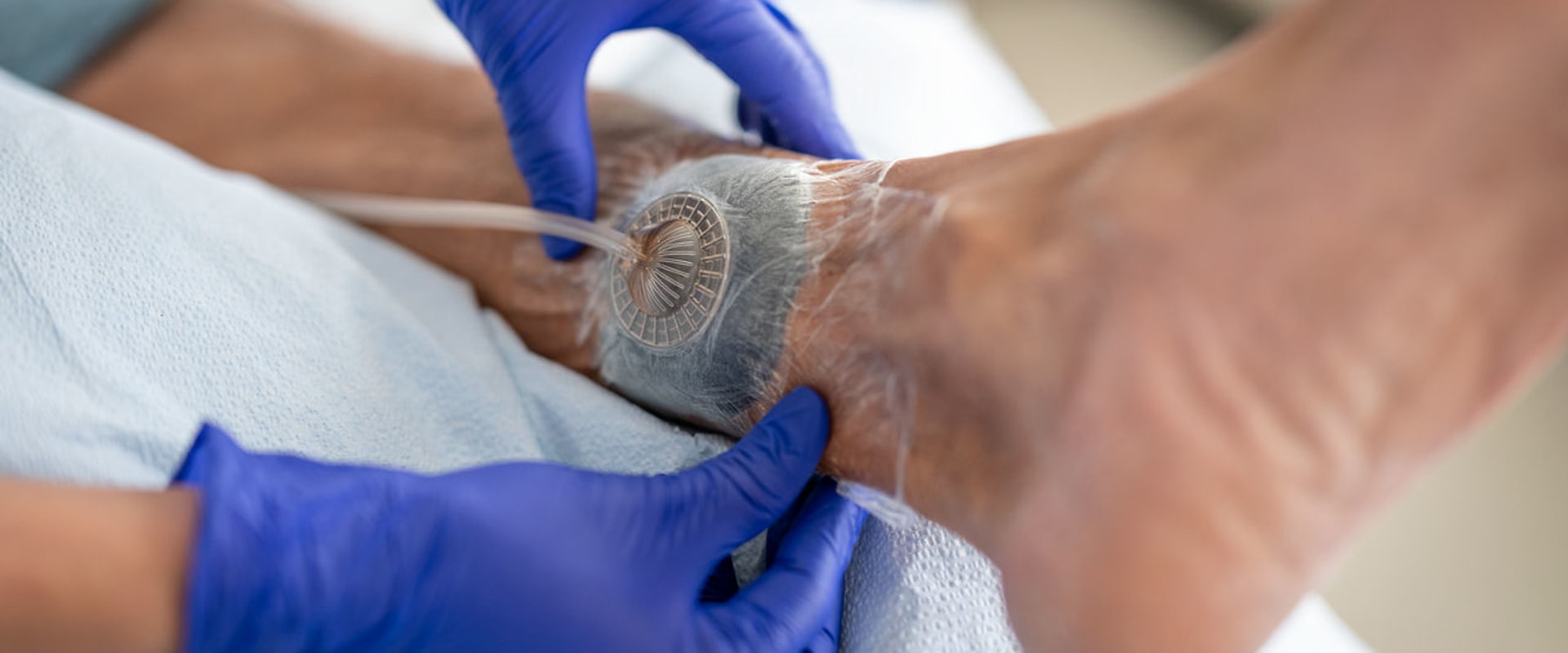 The Versatility of Negative Pressure Wound Therapy: Indications for Wound VAC