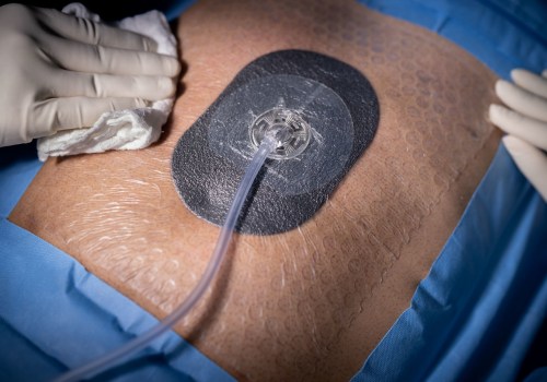 The Power of Wound Vacs: How They Can Revolutionize Wound Healing