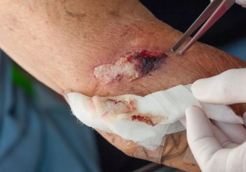 Infected Cuts and Wound Care: What Does an Infected Cut Look Like and How Wound Vac Aids Recovery