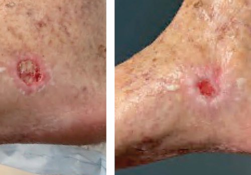 The Process of Wound Aspiration Therapy: What Happens After a Vac Dressing?