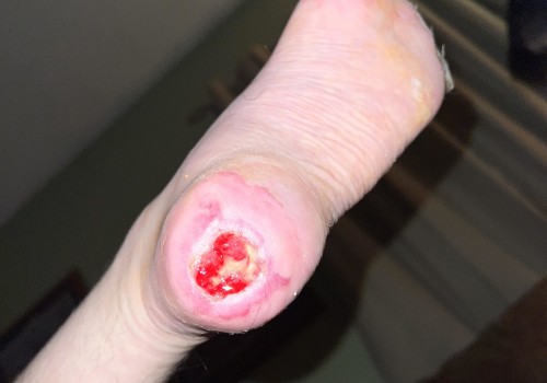 The Importance of Wound Vac Therapy and What Happens When It's Turned Off